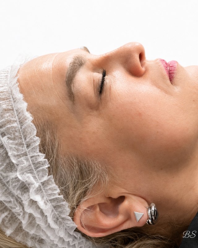 Después de tratamiento de hidratación y volumen facial